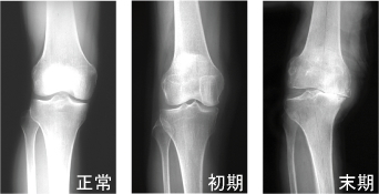 変形性膝関節症画像