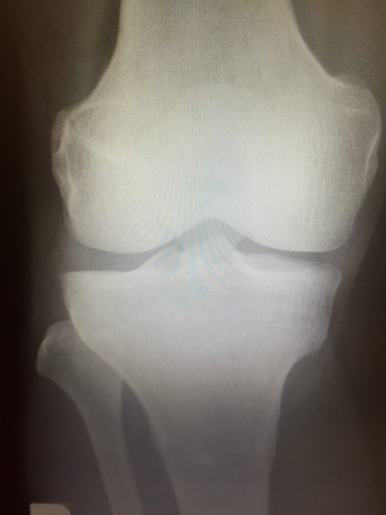膝の痛みレントゲン